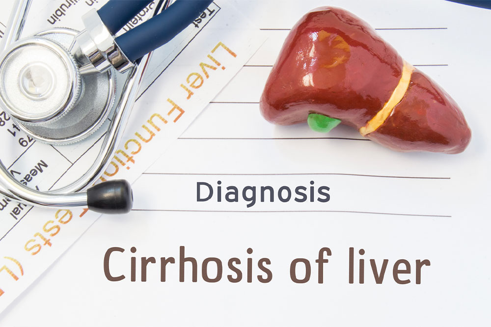 Liver Cirrhosis &#8211; Its Stages and Prevention