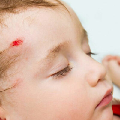 Common head injury symptoms in adults and children