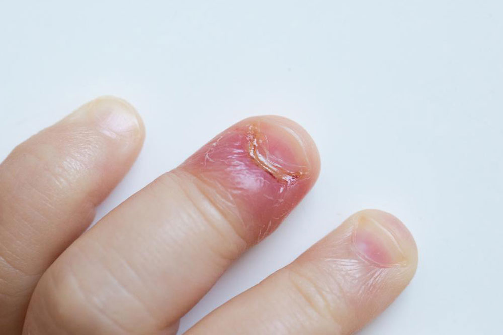 Four reasons for swollen finger pain