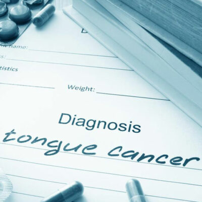 Symptoms of tongue cancer you should not ignore