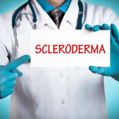 Treating the early symptoms of scleroderma