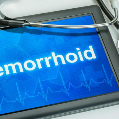 What are the causal factors of hemorrhoids?