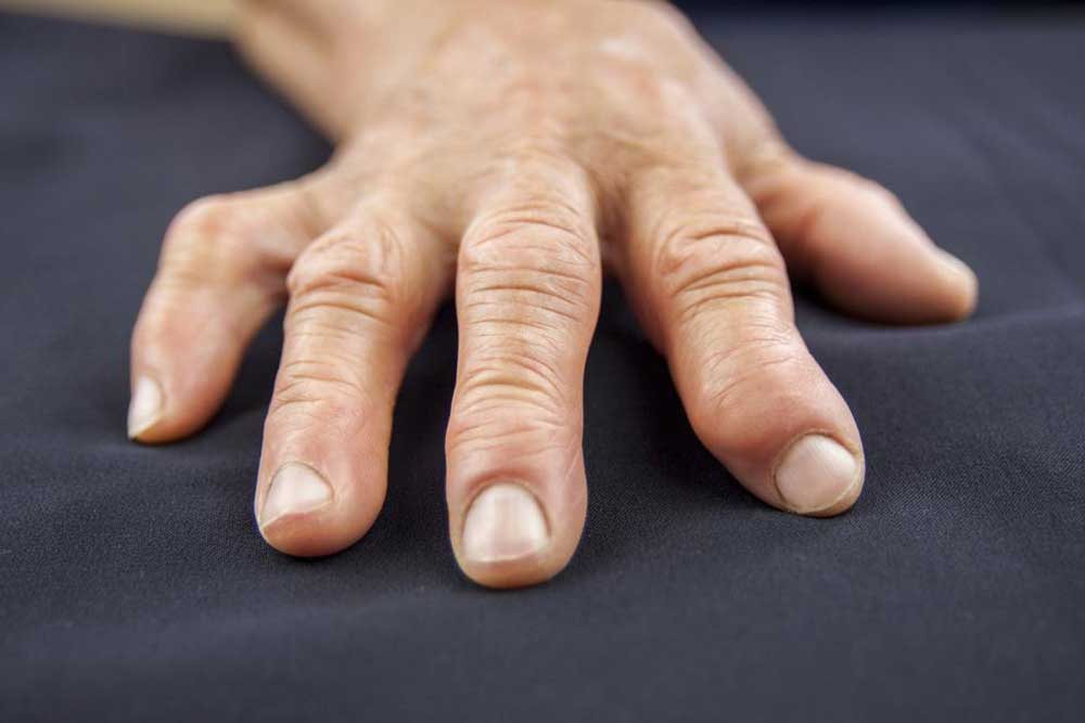 5 Causes of Swollen Fingers