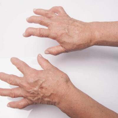 A Quick Guide of Rheumatoid Arthritis Drugs