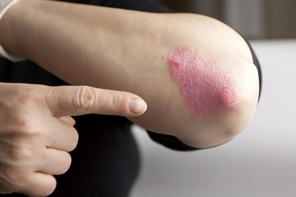 Causes of psoriasis that one needs to be aware of