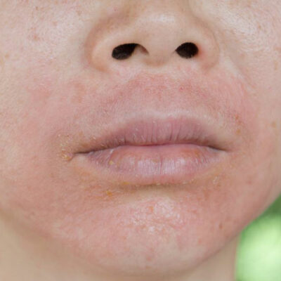 Effective Treatments for Eczema