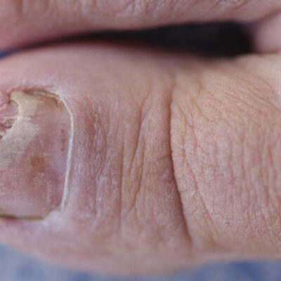 Effective Ways to Treat Toe Fungus