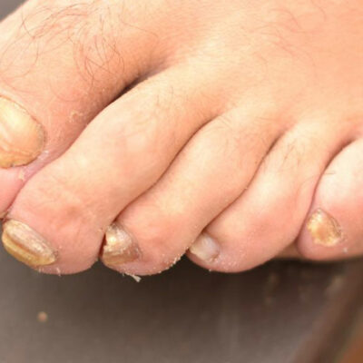 Get Rid of Toenail Fungus Quickly with 6 Home Remedies