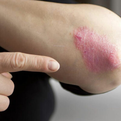 Here Are a Few Things to Know about Psoriasis