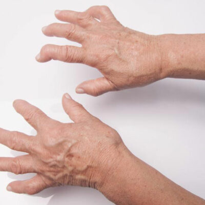 Here&#8217;s What You Need to Know About Rheumatoid Arthritis Symptoms