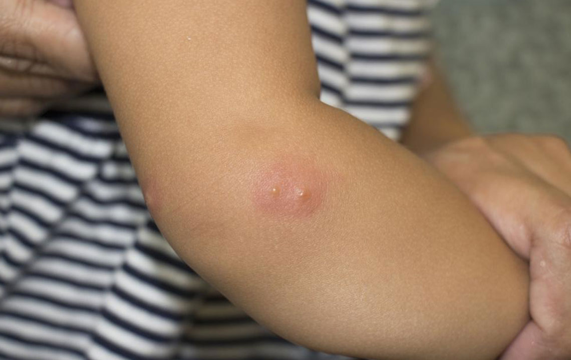 Here&#8217;s What You Need to Know about Shingles and Its Symptoms