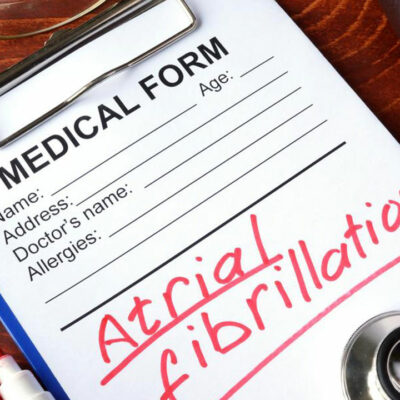 Symptoms, Diagnosis and Treatment of Atrial Fibrillation