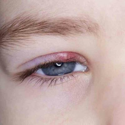 Simple steps to remove styes