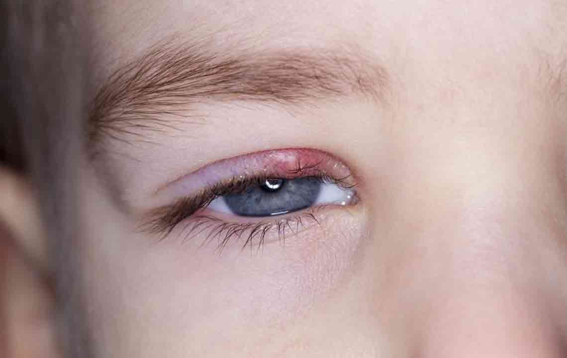 Simple steps to remove styes