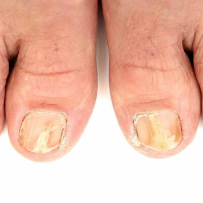 Try These 5 Ways to Effectively Treat Toenail Fungus