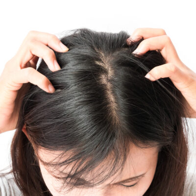 What To Know About Treating An Itchy Scalp