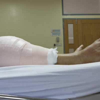 What You Need To Know About Knee Replacement Surgery