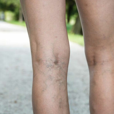 What You Need to Know about Deep Vein Thrombosis