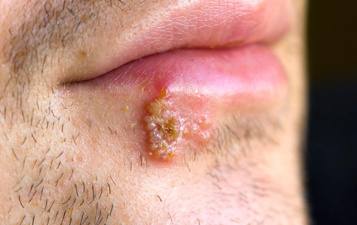 7 Tips for Treating Cold Sores